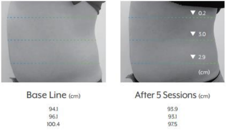 antes y despues lipo x 3