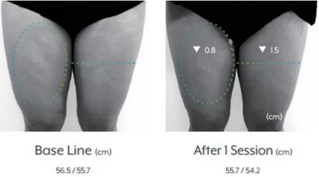 antes y despues lipo x 4