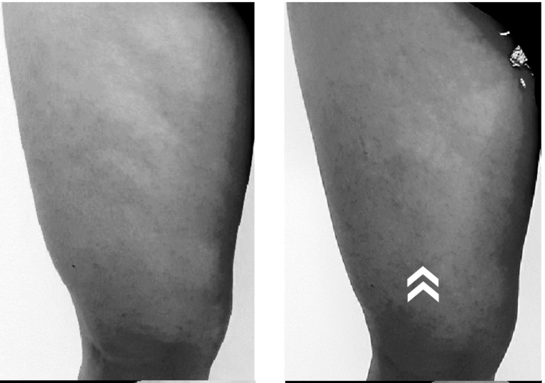 celulitis antes y despues lipo x